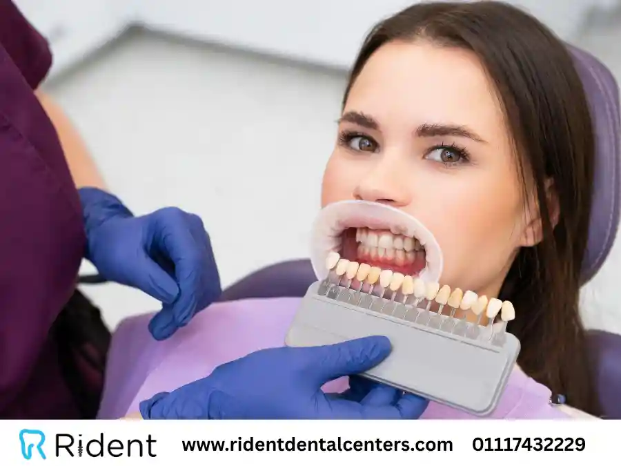 أسعار فينير الأسنان و7 نصائح لأفضل النتائج